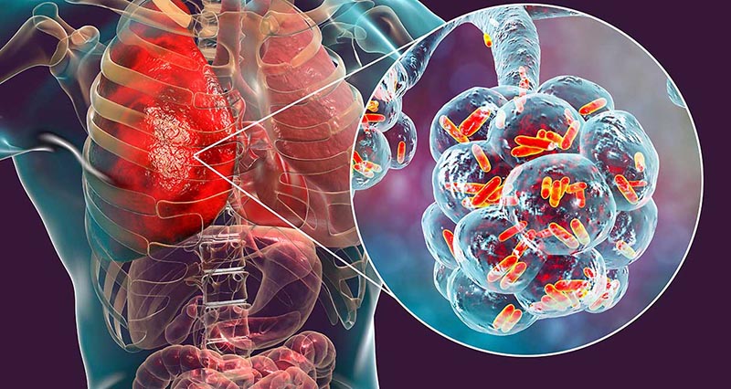 Vi khuẩn Legionella trong tháp giải nhiệt gây bệnh viêm phổi